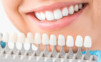 Dental Veneers Treatment