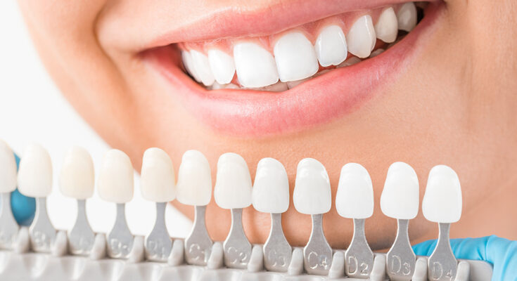 Dental Veneers Treatment