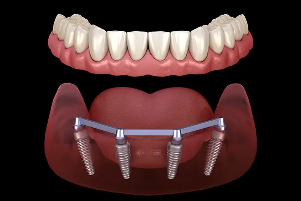 All-on-4 Dental Implant