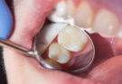 Dental Fillings