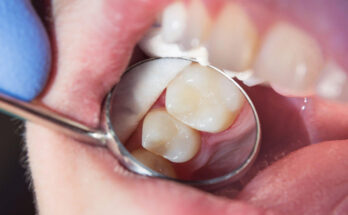 Dental Fillings