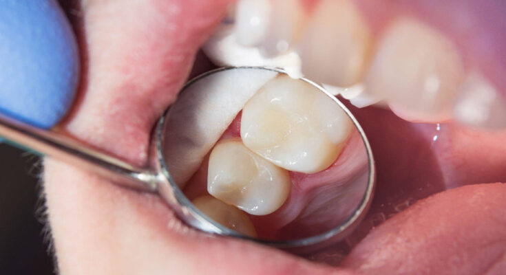 Dental Fillings