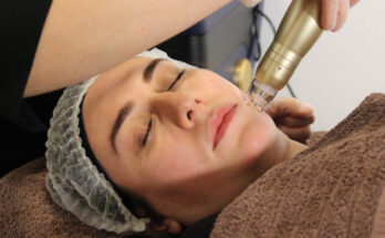 Microneedling