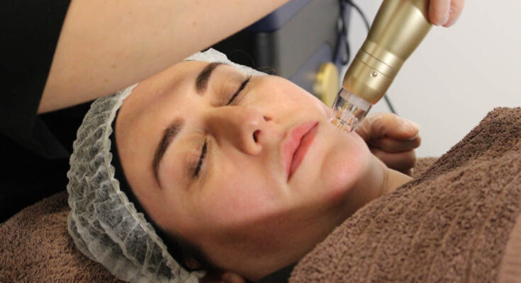 Microneedling