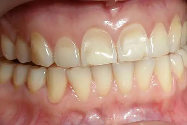 Tooth Erosion