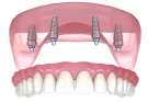 All-on-4 Dental Implant