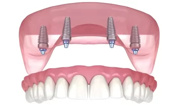 All-on-4 Dental Implant