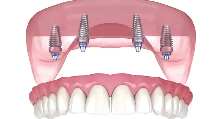 All-on-4 Dental Implant