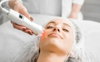 Pico Laser Treatment